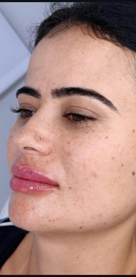 Preenchimento labial