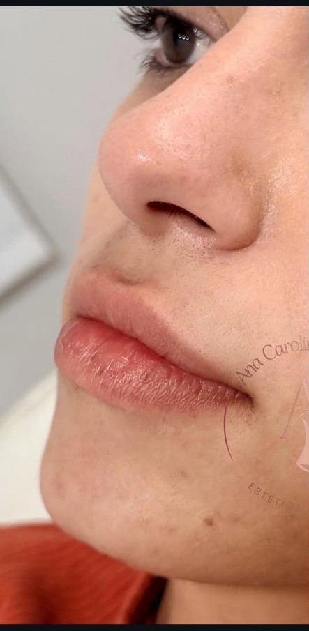 Harmonização facial