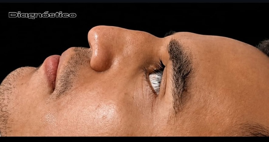 Perfil nasal antes da rinomodelação